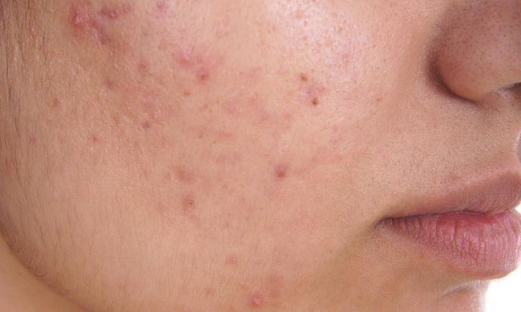 Acne and Skin Issues