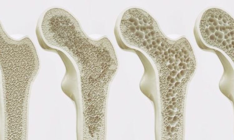 Testosterone and Bone Density